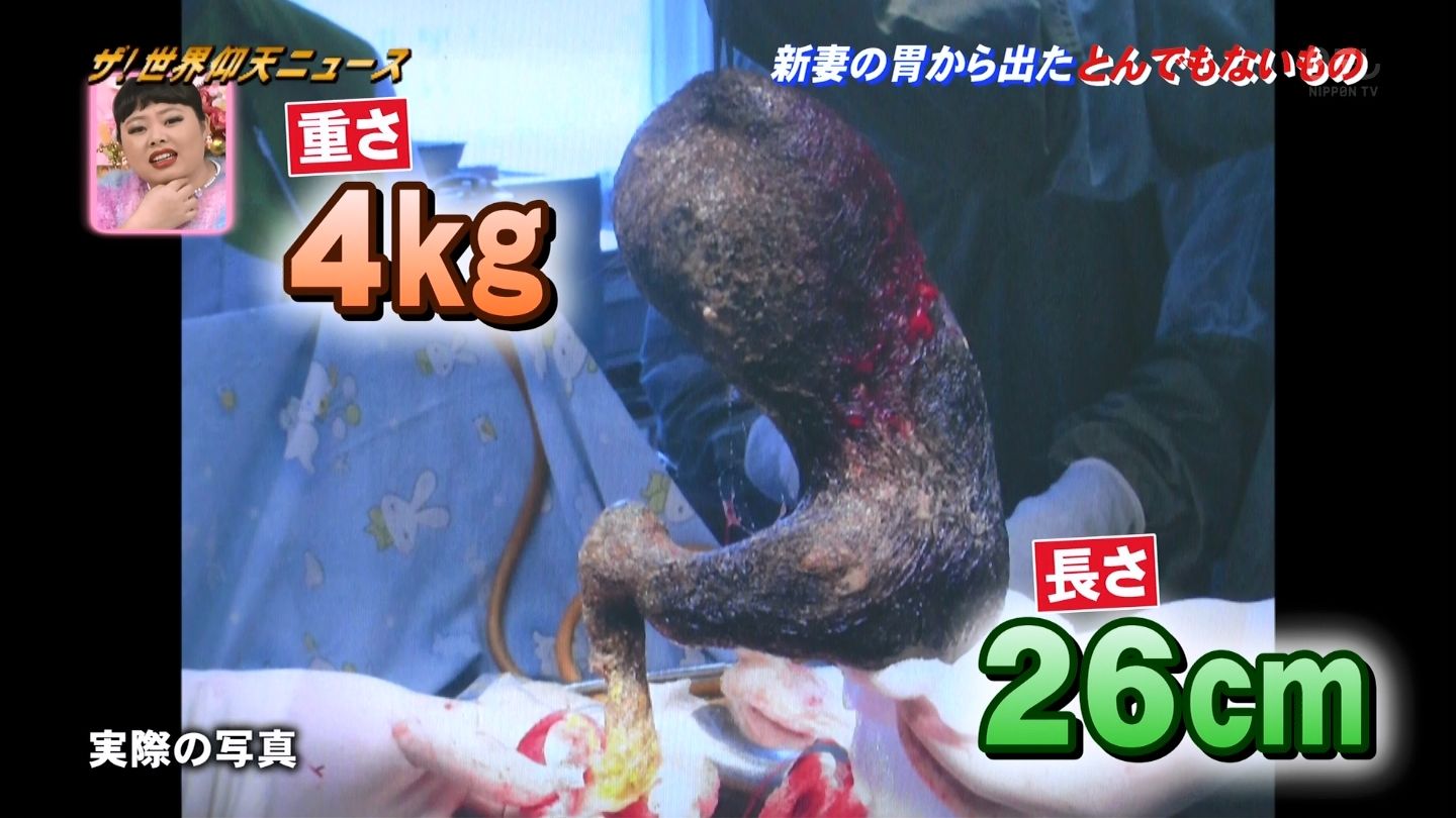 食毛症になった女性の胃から出た髪の毛が衝撃的すぎる 仰天ニュース画像 独女ちゃんねる 食毛症になった女性の胃から出た髪の毛が衝撃的すぎる 仰天ニュース画像 独女ちゃんねる