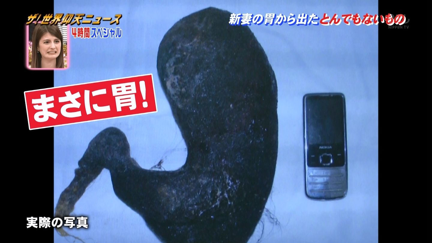 食毛症になった女性の胃から出た髪の毛が衝撃的すぎる 仰天ニュース画像 独女ちゃんねる 食毛症になった女性の胃から出た髪の毛が衝撃的すぎる 仰天ニュース画像 独女ちゃんねる
