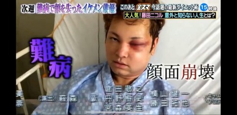 間瀬翔太 顔面崩壊した病気 (4)