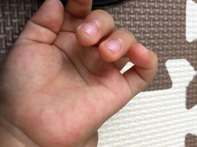 1歳半 軽めの手足口病になりました 症状の経過まとめ ぷーやへささげるeveryday