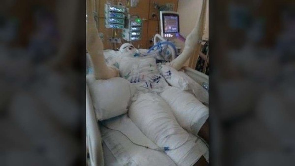 180821-girl-burned-in-fire-challenge