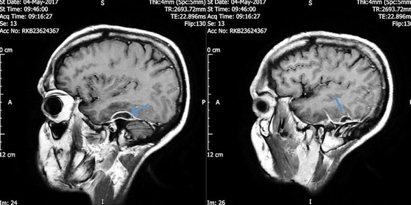 lodged-cotton-swab-skull-infection