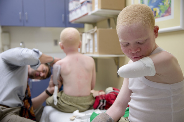 ct-africa-albino-children-20150818