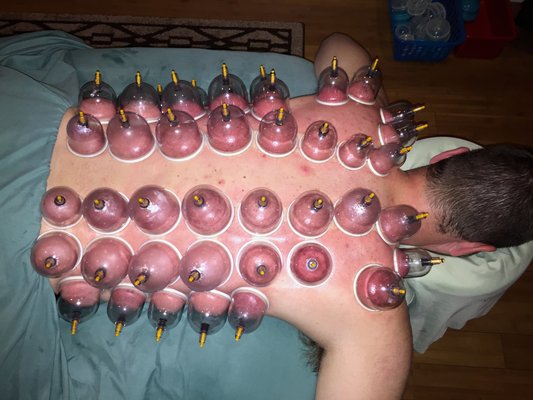 cupping3